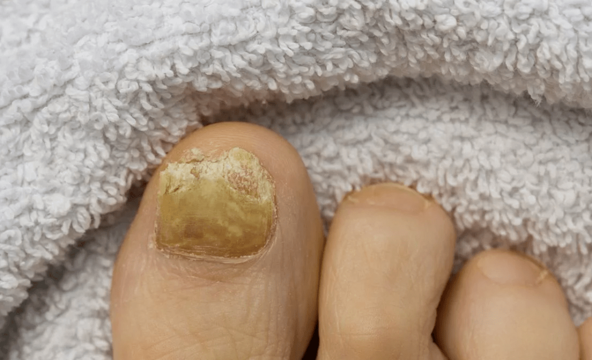Nagelpilz