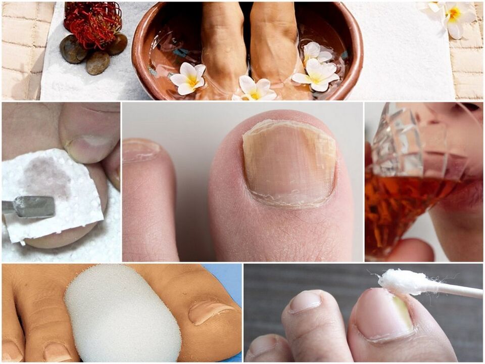 Nagelpilzbehandlung
