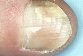 Schädigung der Nagelplatte durch eine Pilzinfektion